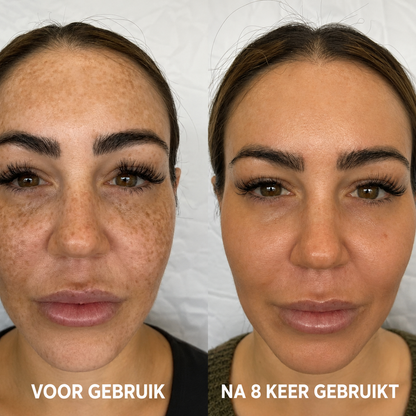 Geavanceerd Triple Acid Complex tegen Hyperpigmentatie