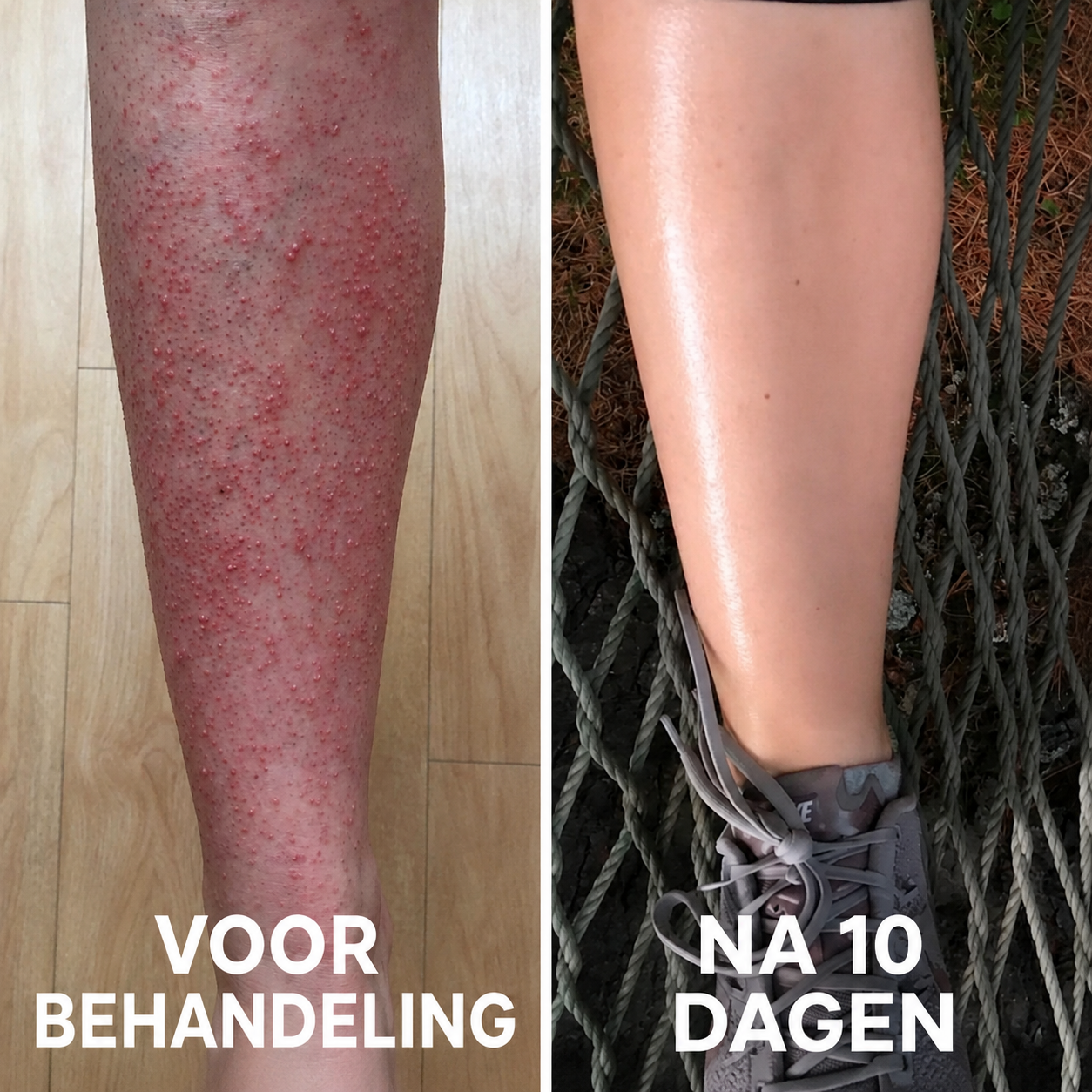 Geavanceerd Triple Acid Complex tegen Keratosis Pilaris