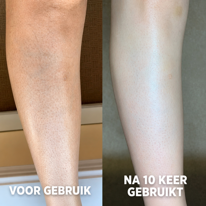 Geavanceerd Triple Acid Complex tegen Keratosis Pilaris